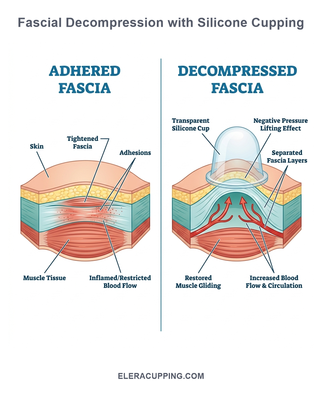 Side-by-side anatomical infographic showing adhered thoracolumbar fascia vs decompressed fascia with cupping therapy.